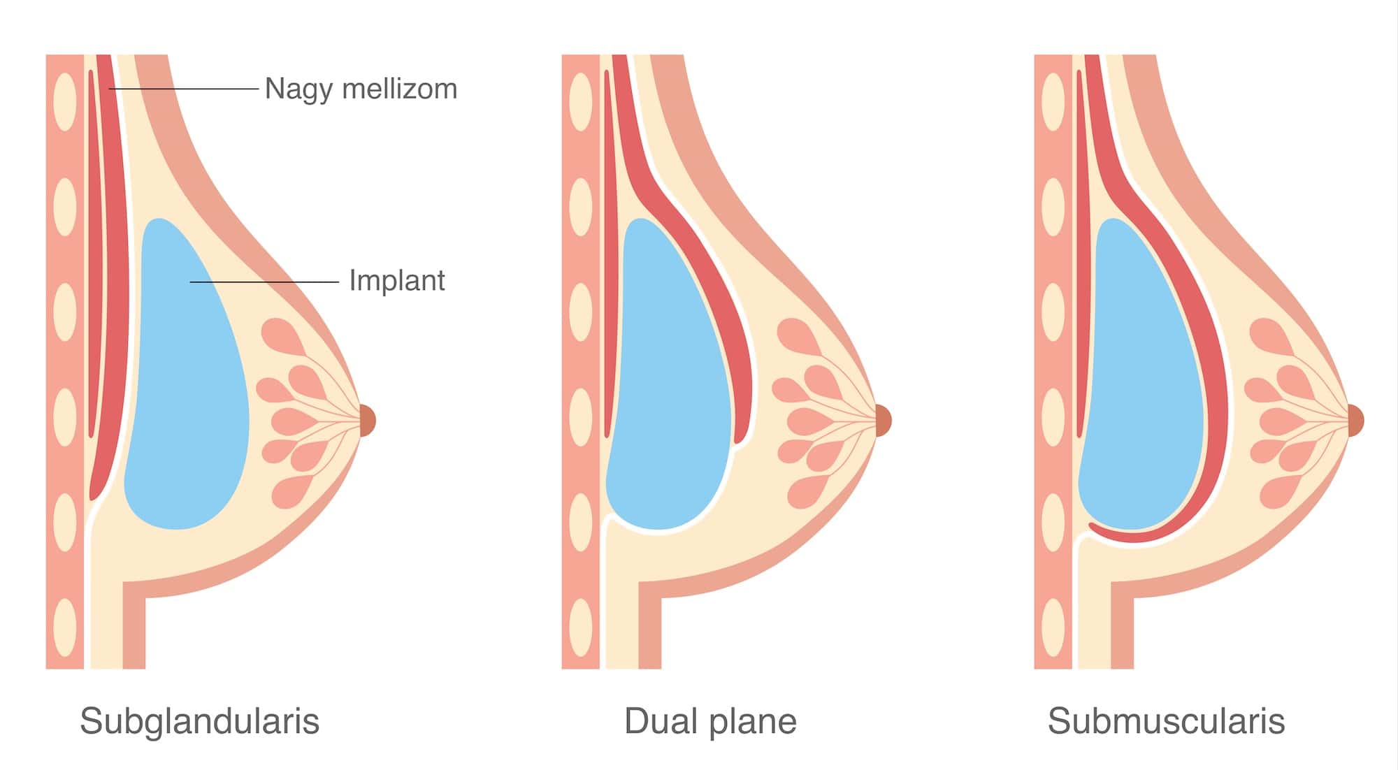 Implant pozíció